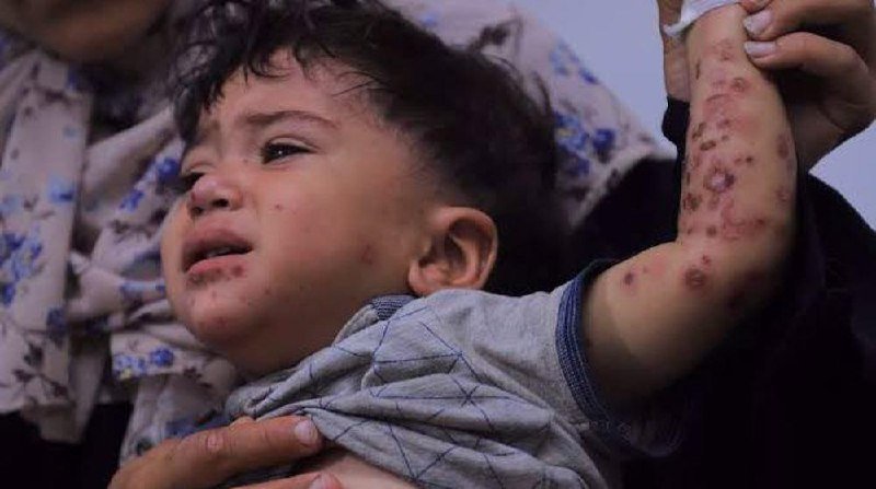 A crying young child with dark, inflamed spots and lesions on his face, arm, and hand is being held by an adult wearing a floral-patterned garment.