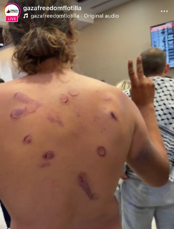 A shirtless person displays multiple circular bruises and abrasions across their back while making a peace sign, with a flight information screen visible in the background.