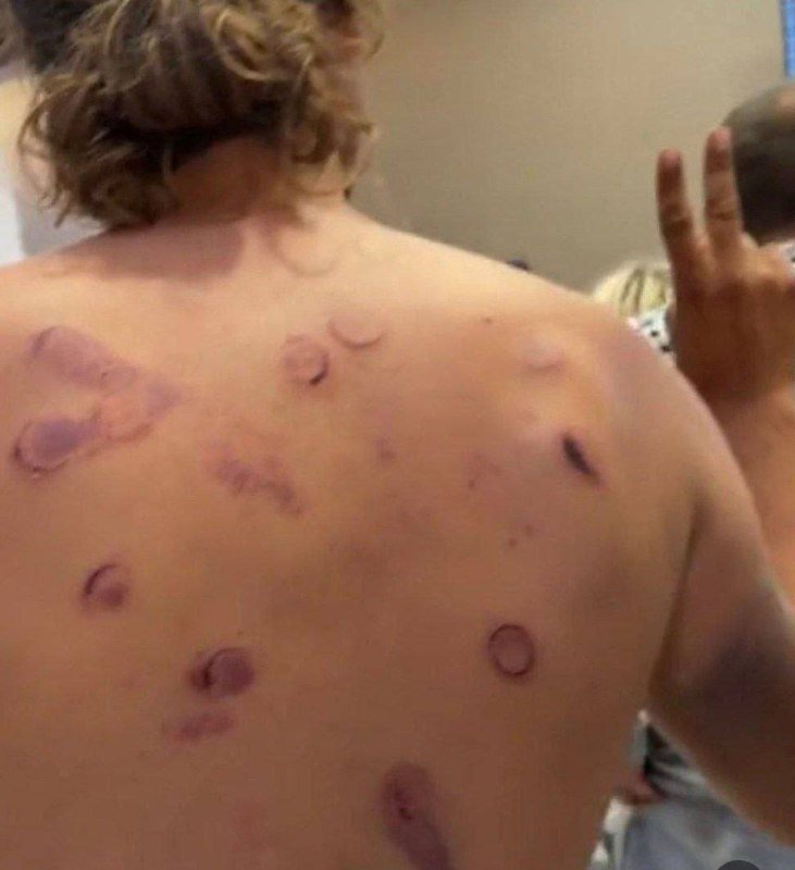 A shirtless person shows numerous round, reddish suction marks and bruises scattered across their back.